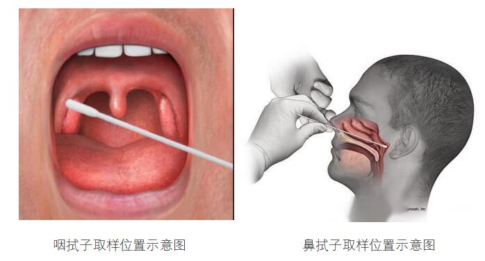 咽拭子取样示意图.jpg